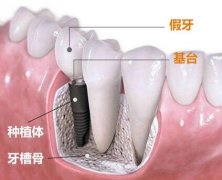 种植牙的利与弊分别有哪些?想听详细分析~ width=