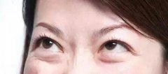像大幂幂这种双眼皮都会成为多重睑？？ width=