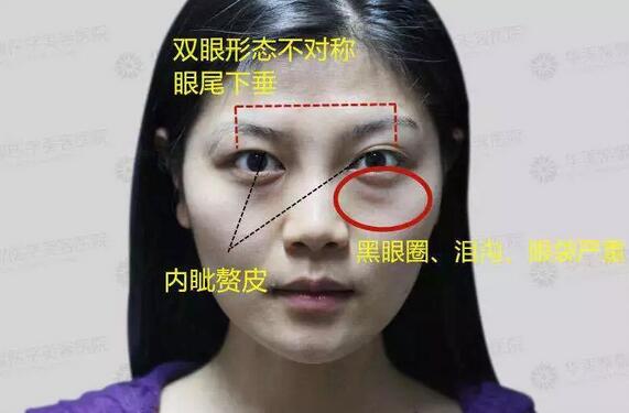 像大幂幂这种双眼皮都会成为多重睑？？