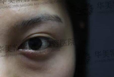 像大幂幂这种双眼皮都会成为多重睑？？