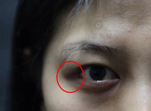 像大幂幂这种双眼皮都会成为多重睑？？