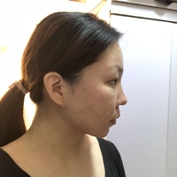 去颊脂垫有副作用吗?行家为了做较的解答