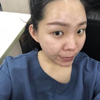 去颊脂垫有副作用吗?行家为了做较的解答