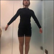 卓彦整形光纤溶脂瘦大腿96天对比图：自己吃出来的肉自己会吸出来! width=