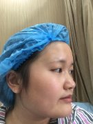 肥胖下颌角手术价格+案例分享：157天丑女变身网红美女！ width=