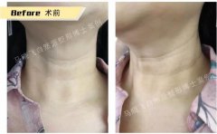 有颈纹怎么办？NBL细胞支架，帮你长久去除颈纹！ width=