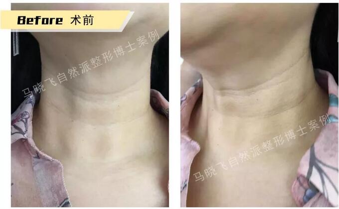 有颈纹怎么办？NBL细胞支架，帮你长久去除颈纹！