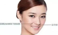 玻尿酸填充法令纹|法令纹不仅仅是老年人的标记哦！ width=