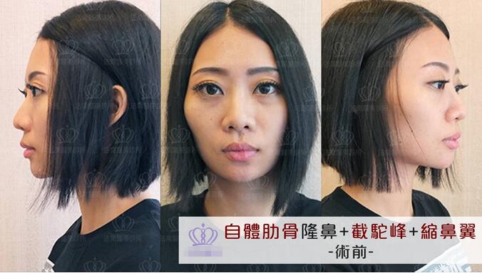 鼻翼缩小对比图|拥有鼻形不再是梦！