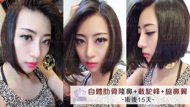 鼻翼缩小对比图|拥有鼻形不再是梦！