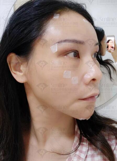 自体脂肪隆额头真实案例，  隆额头后的她尽显年轻化神话!