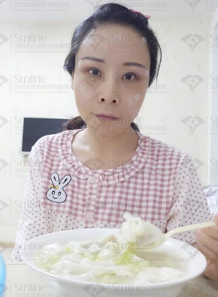自体脂肪隆额头真实案例，  隆额头后的她尽显年轻化神话!