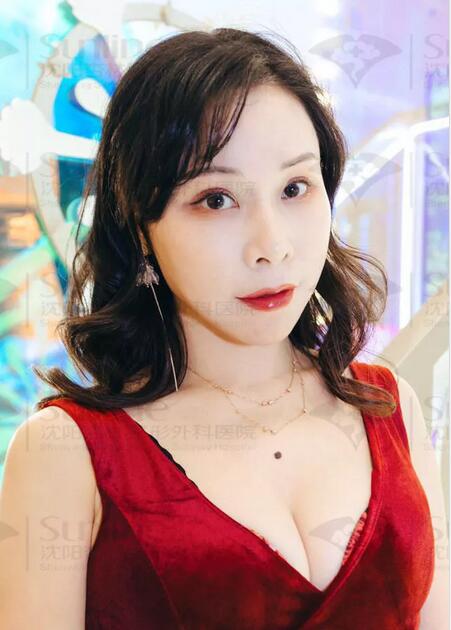 自体脂肪隆额头真实案例，  隆额头后的她尽显年轻化神话!