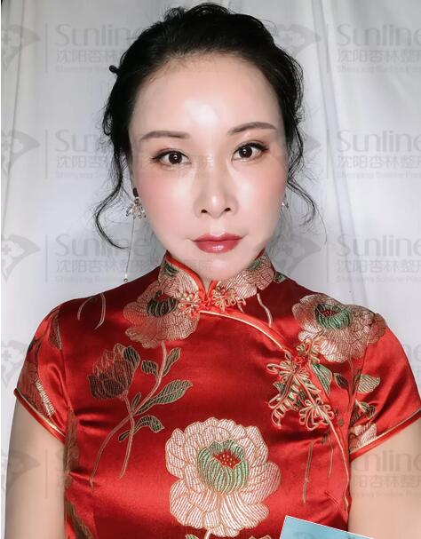自体脂肪隆额头真实案例，  隆额头后的她尽显年轻化神话!