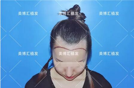 植信植发医院靠谱吗？安琪用经历力推植信植发医院！