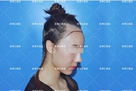 植信植发医院靠谱吗？安琪用经历力推植信植发医院！