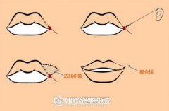 嘴角上扬术恢复期大概是多长呢? width=