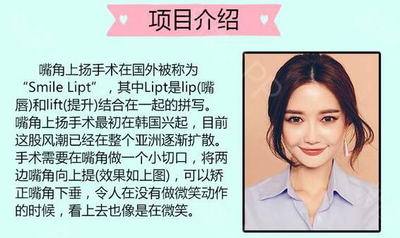 嘴角上扬术恢复期大概是多长呢?