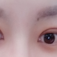 重庆真伊整形怎么样?做双眼皮果如何?