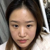 惠州鹏爱医院郭振宇教授的个性化隆鼻技术到底怎么样?