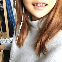 袁志杰牙齿矫正技术如何?恢复期需要多久?