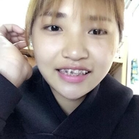 袁志杰牙齿矫正技术如何?恢复期需要多久?