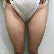 韩式共振吸脂减肥案例：罗汉腿96天消失恢复之路~ width=
