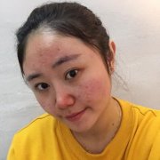 像素激光调节痘疤恢复案例分享：去除这个痘疤折腾了十多年~ width=