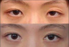 上睑下垂矫正后遗症有哪些? width=