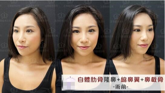 王艇隆鼻