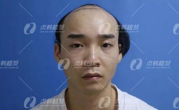 植信植发医院正规吗？田先生在植信植发医院解决了脱发困扰！