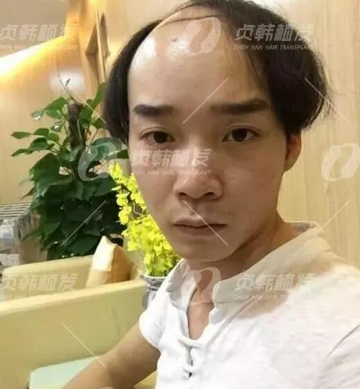 植信植发医院正规吗？田先生在植信植发医院解决了脱发困扰！