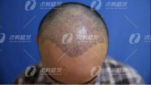 植信植发医院正规吗？田先生在植信植发医院解决了脱发困扰！