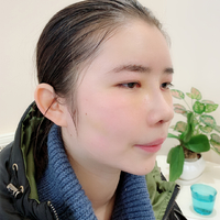 杭州同欣整形医院注射隆鼻项目怎么样?微创隆鼻不是梦