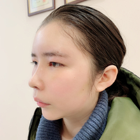 杭州同欣整形医院注射隆鼻项目怎么样?微创隆鼻不是梦