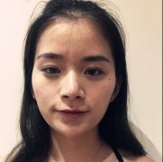 卓星整形韩式分段隆鼻案例对比图1-67天恢复分享 width=