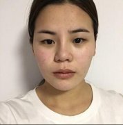 任贝贝微创双眼皮前后对比图案例：以前我的双眼皮都是胶水粘的~ width=