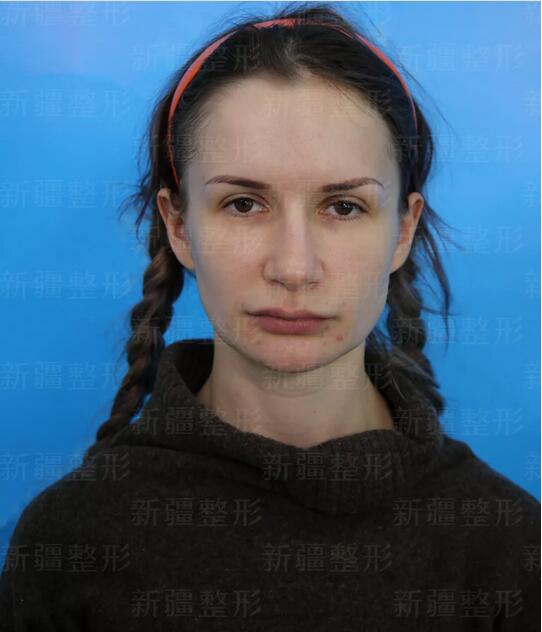自体脂肪移植隆胸术做了后，瘦身丰胸一举两得！