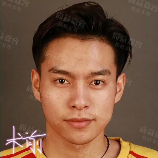 【黎星太阳穴+下巴脂肪填充案例】知名主持人西墨，要做精致boy~