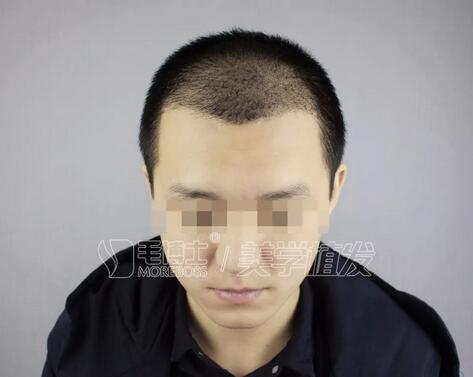 新发现植发后不到半年，邱先生头顶“茂密数林”~