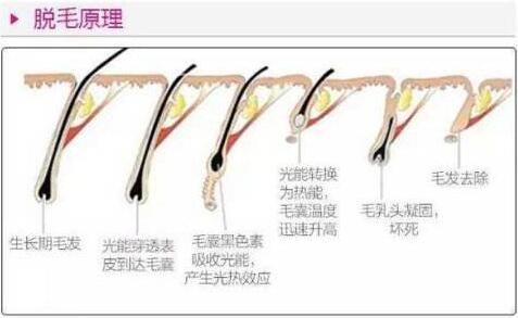 冷光量子脱毛有哪些优势?