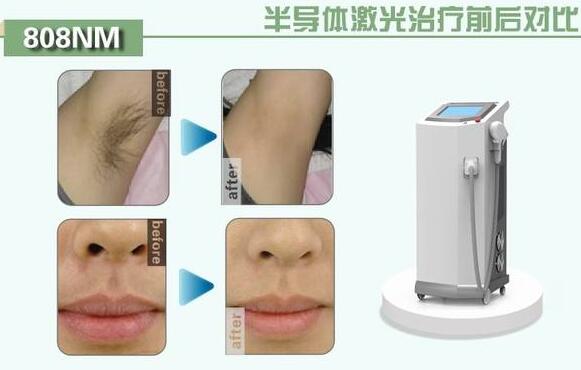 冷光量子脱毛有哪些优势?