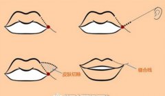 上海九院嘴角上扬术果好吗? width=