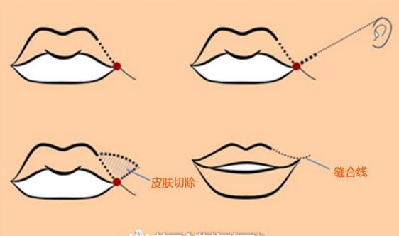 上海九院嘴角上扬术果好吗?
