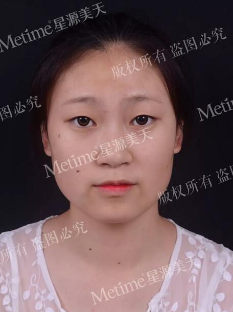上眼皮松弛矫正术+贝塞尔微创双眼皮，颜值回春全靠它！