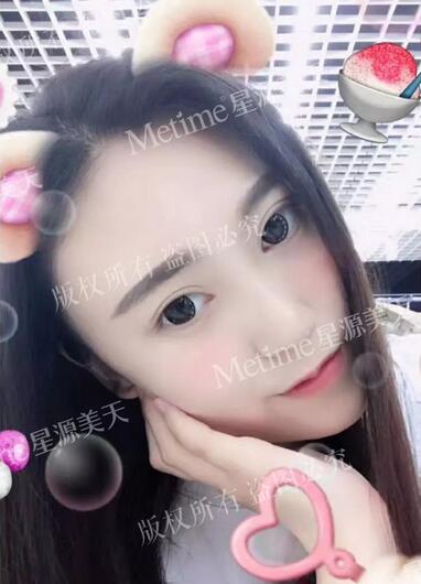 上眼皮松弛矫正术+贝塞尔微创双眼皮，颜值回春全靠它！