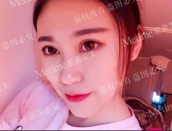 上眼皮松弛矫正术+贝塞尔微创双眼皮，颜值回春全靠它！