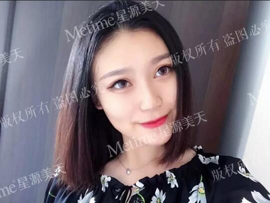 上眼皮松弛矫正术+贝塞尔微创双眼皮，颜值回春全靠它！