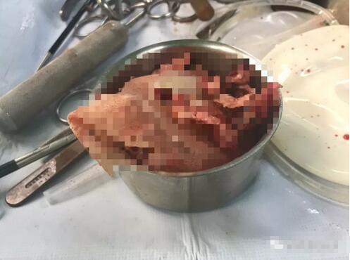 刘成胜高难度隆胸修复手术纪实，一起见证刘成胜医生的实力！