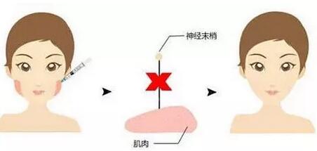 打注射瘦脸会面瘫吗?  小敏的前后对比图来作答!